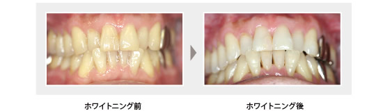 ホワイトニング写真